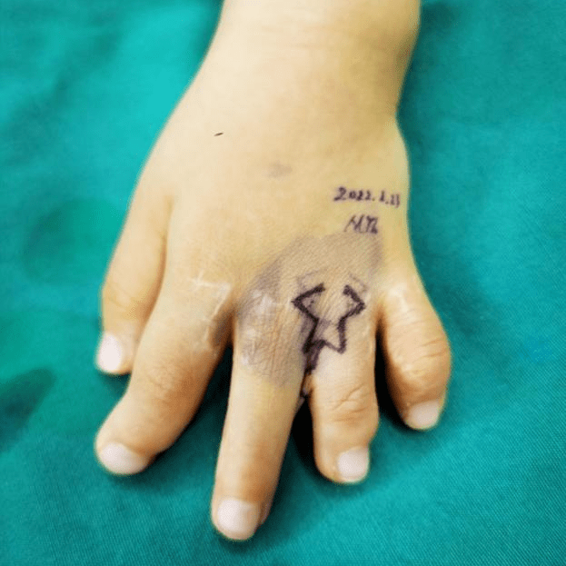 poland_综合征_波兰