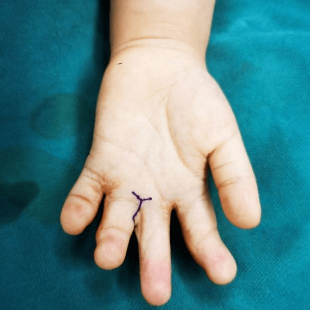 poland_综合征_波兰