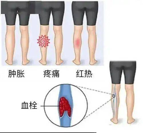 护理园地 下肢静脉血栓早发现早预防_因素_正在进行_活动期