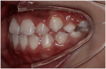 自信美丽的笑脸,来自洁白整齐的牙齿_上颌_前牙_孩子