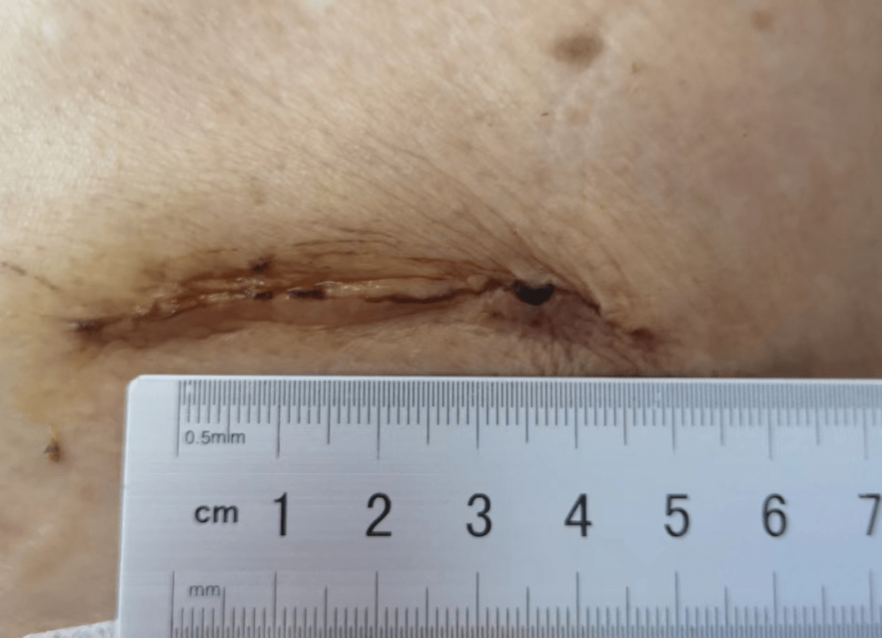 八旬老人多发肋骨骨折,微创手术次日即可下床活动