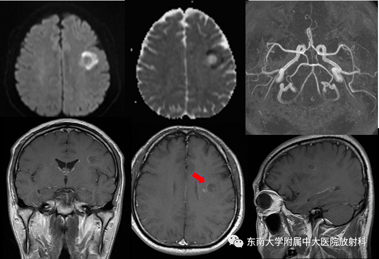 脫髓鞘假瘤影像學表現