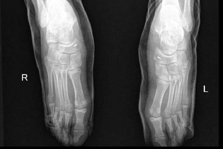 【术后复查x线显示:双足副舟骨已切除,胫后肌腱重建处可见铆钉固定】