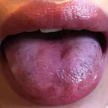 首先,瘀血之人,舌头的舌边和舌尖,容易出现瘀斑和瘀点