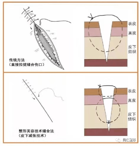 骨折一期愈合图片