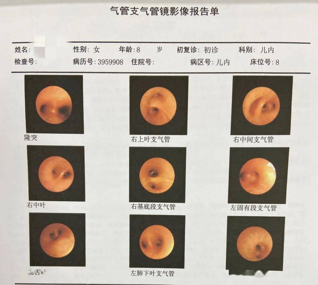 支气管镜检查:双肺支气管各段粘膜充血,肿胀,可见纵行皱褶,支气管灌