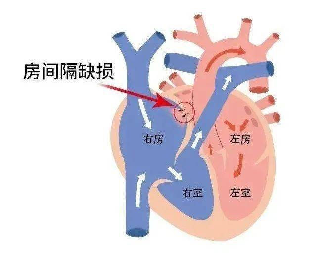 房间隔位置图片