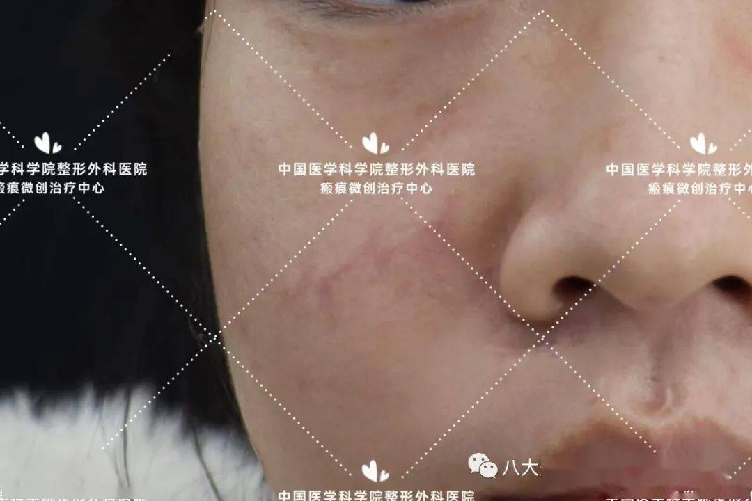 超减张缝合案例分享