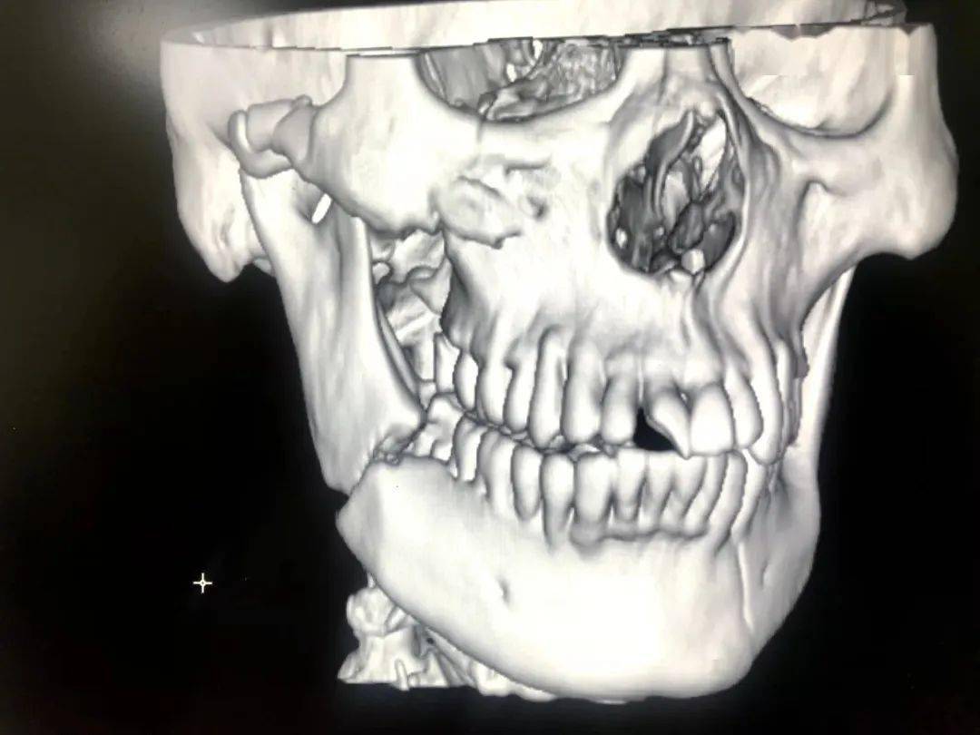 上颌骨鼻前棘骨折图片