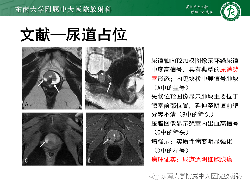 女性尿道生殖膈區佔位性病變的影像診斷