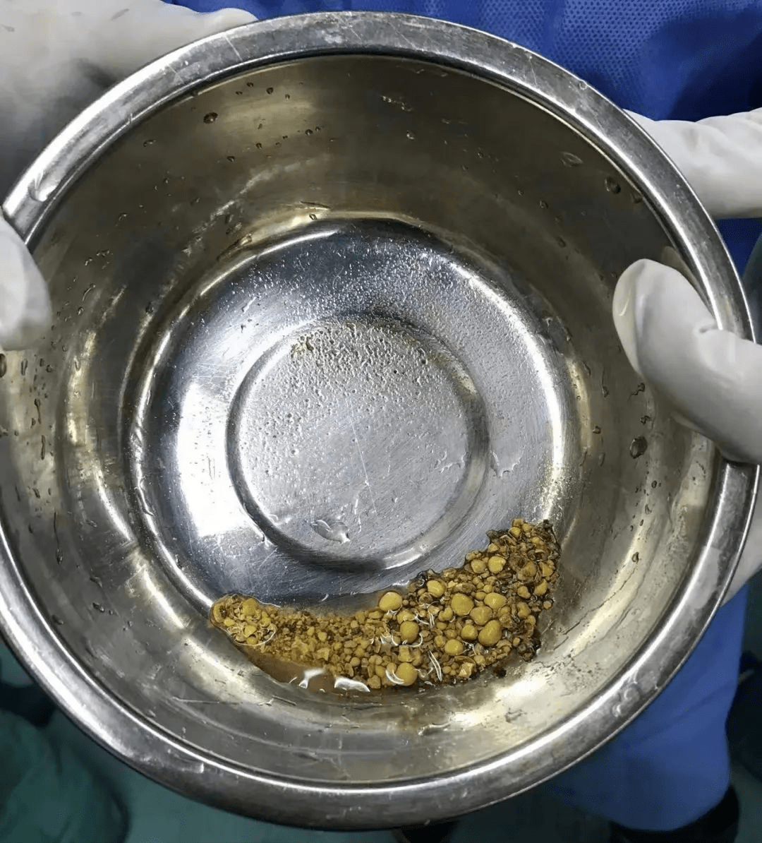 260斤胖哥微创手术,竟取出大把肾结石_经皮_患者_石门县