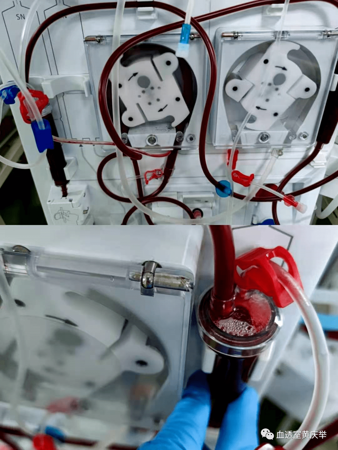 血液透析中发生凝血怎么办