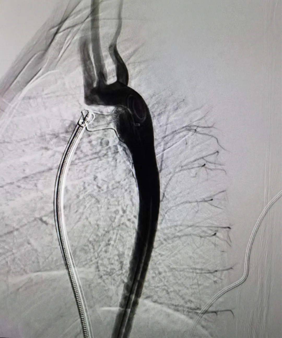 多科协作,将1岁半女童大到6毫米的心脏缺口给堵严实了