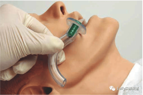 【看图说话】小议气道及气管插管工具