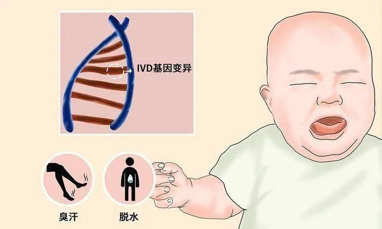 科普臭脚丫气味的遗传代谢病异戊酸血症