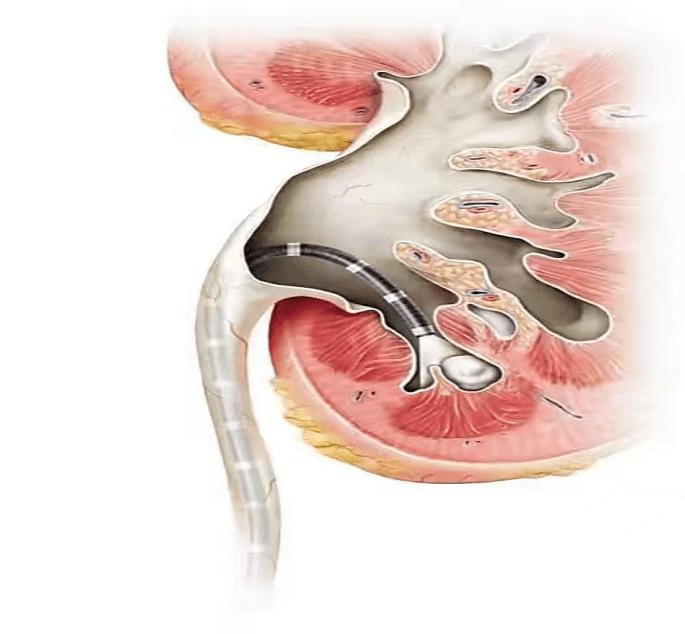 利用一條直徑3mm左右的細鏡,靈活經過尿道,膀胱,輸尿管進入腎臟,將輸