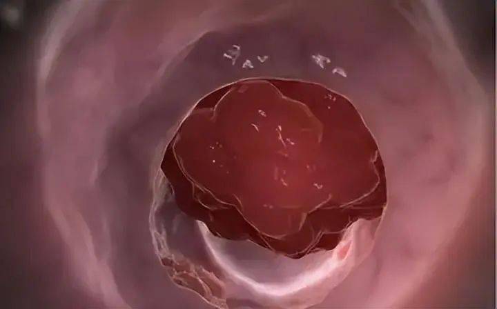 早期肠癌大便图片粘液图片