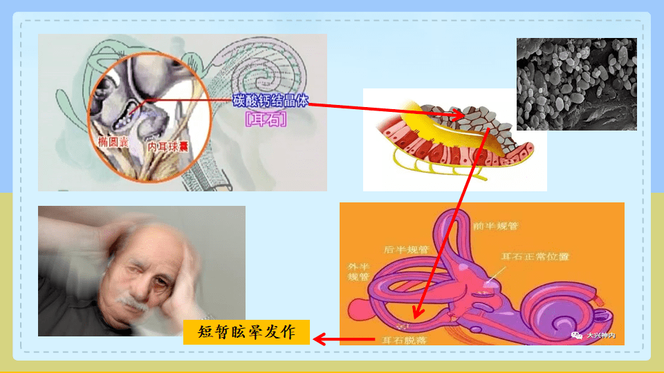 【專家講科普】眩暈怪病——耳石症67_內耳_包括_位置