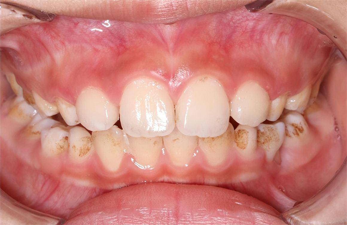 有的宝宝牙齿长着长着,牙面就从白色变成了棕褐色甚至黑色,这是龋齿的