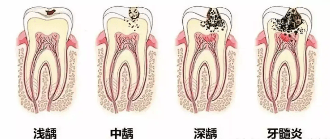 牙齿已经烂到根部,这样就没有办法进行有效的修复,就只能拔掉烂根