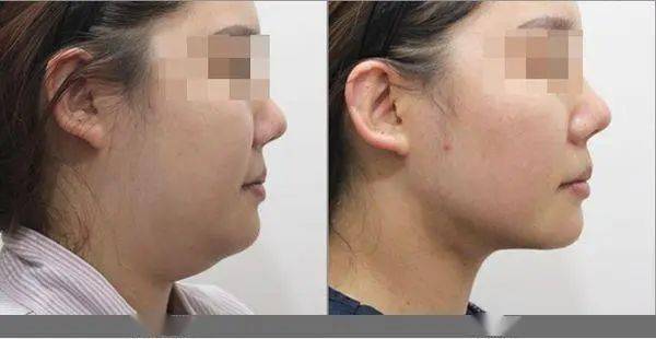 素注射适用于先天的下颌骨整体轮廓感不强,或肥胖,导致下颌线不清晰