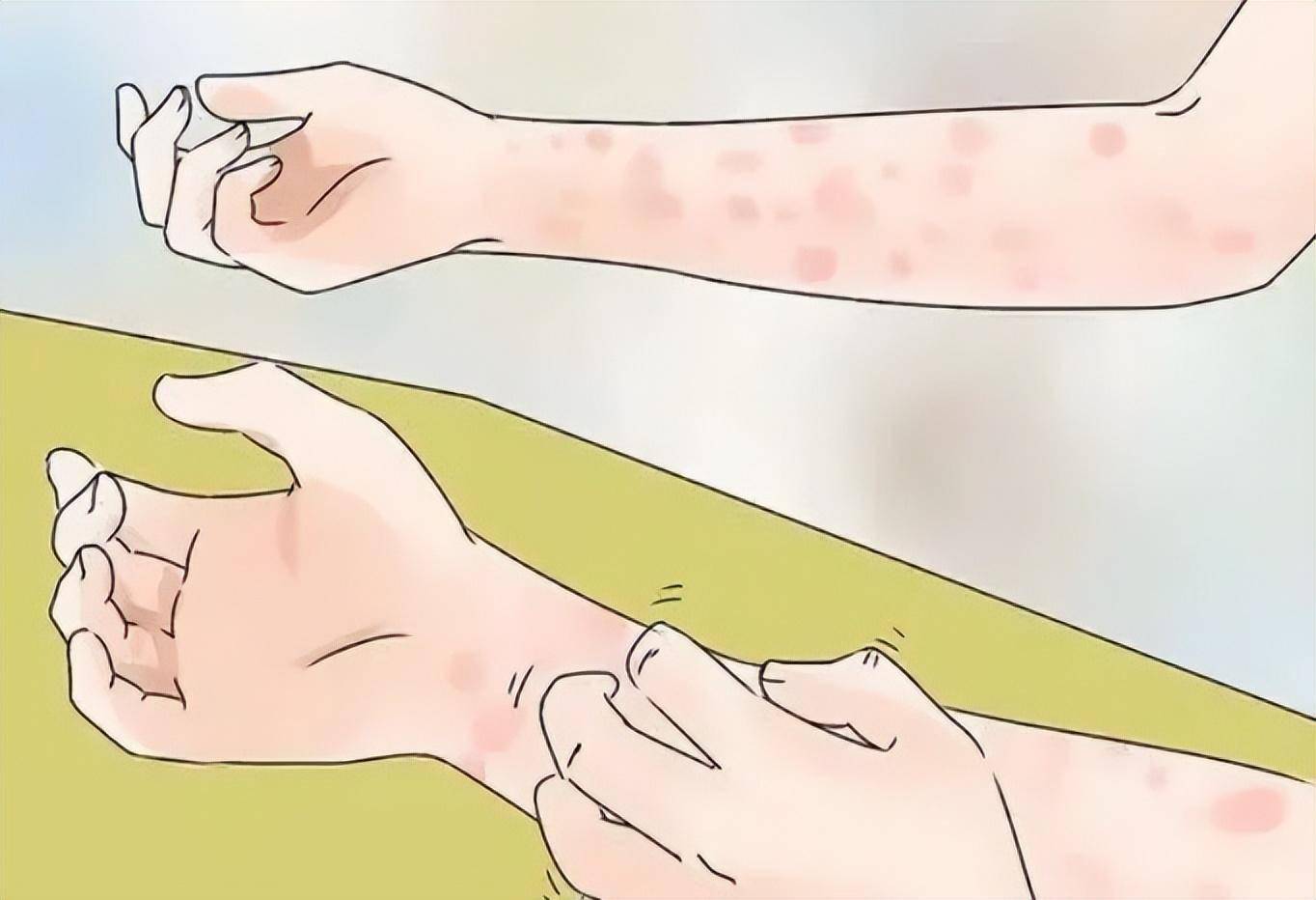 虫咬性皮炎治疗方法图片