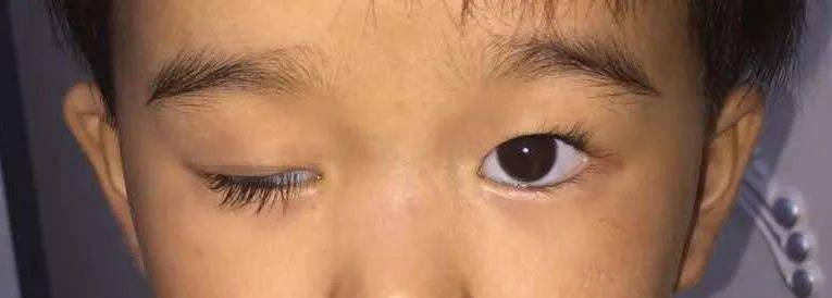 "卷帘神器 "——新材料矫正重度上睑下垂_手术_影响_右眼