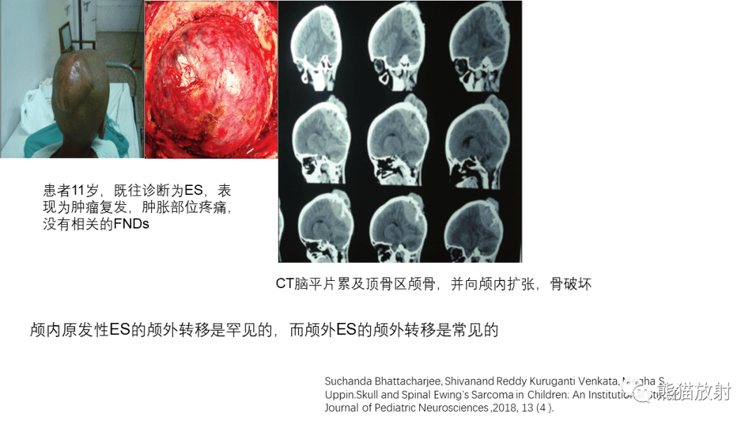 颅骨多发性骨髓瘤图片