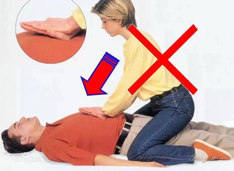 气道异物梗阻失去反应后,用卧位腹部冲击法还是心肺复苏法?