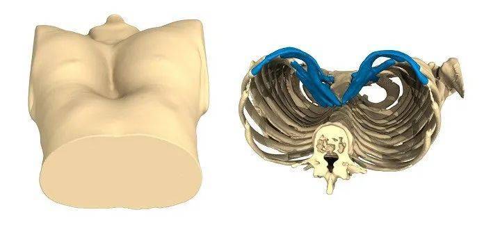 【客戶案例】artec3d與geomagicfreeform為先天性胸廓畸形患者定製