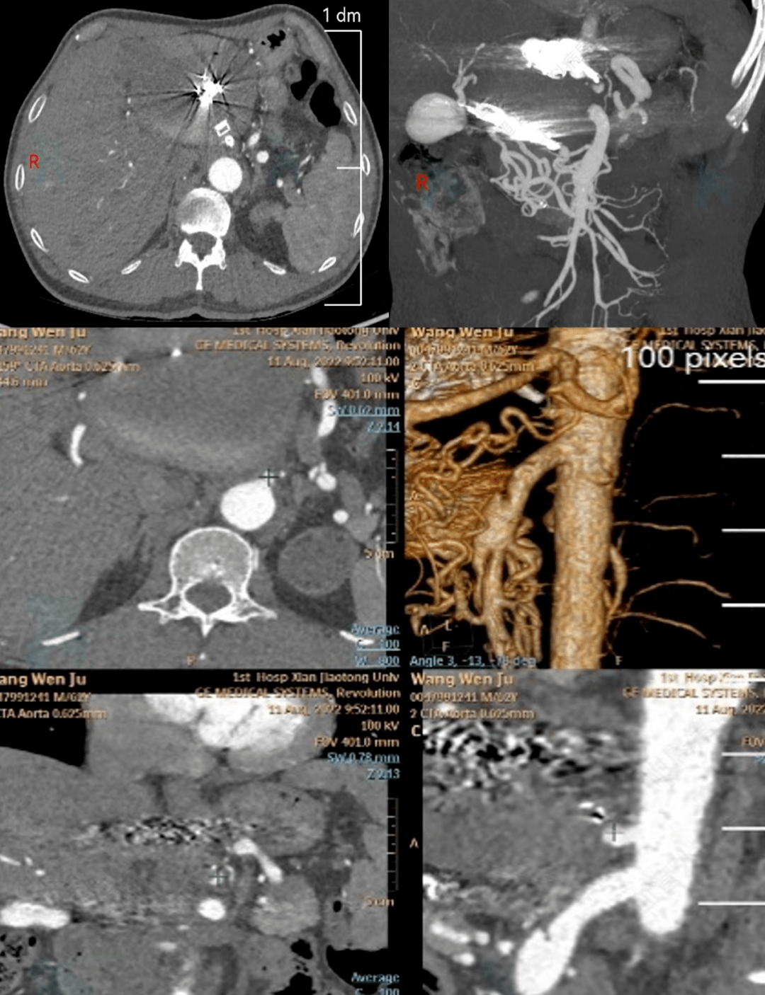 刘超:avp Ⅱ血管塞治疗腹腔干假性动脉瘤_栓塞_中国_造影