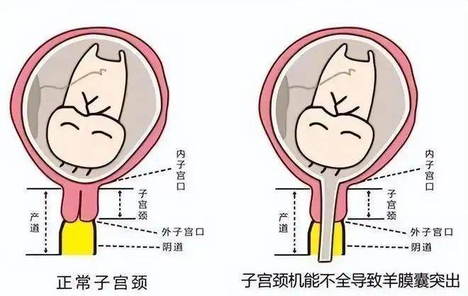 羊膜囊突入宫颈管图片