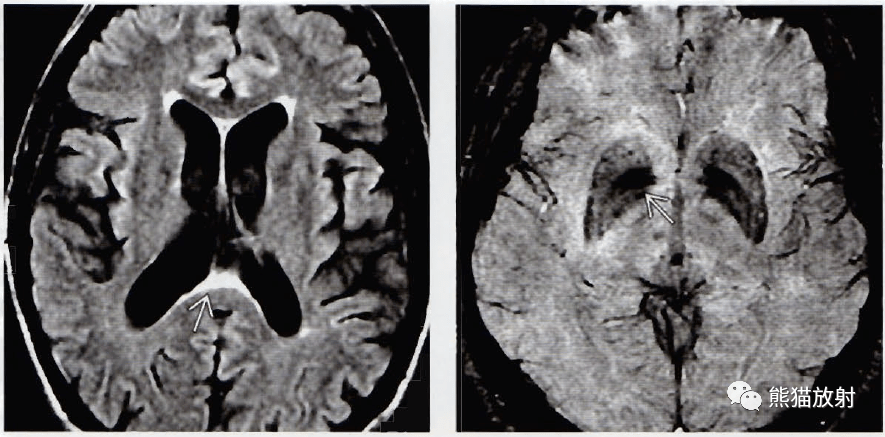 正常老年性脑改变,血管性痴呆丨影像诊断要点