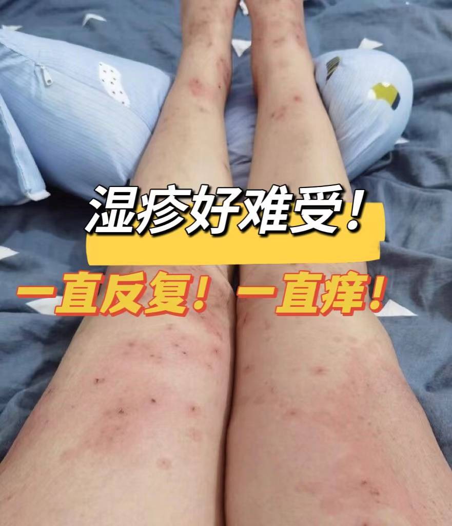 顽固湿疹两年没犯病的原因竟是这个!没亲自用过也不敢这么说!