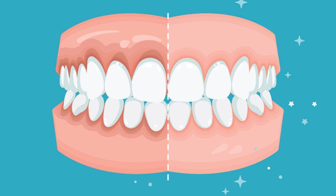 西安圣贝科普 | 牙龈上长脓包是怎么回事?_炎症_牙根_牙齿