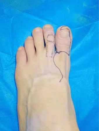 【案例分享】足趾移植再造拇指病例一例