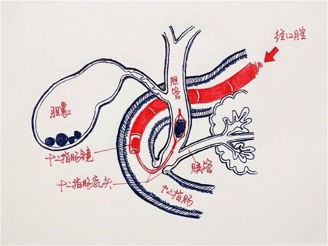 胰管和胆总管的解剖图图片