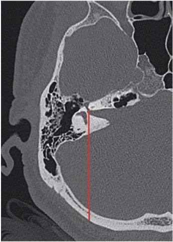 【ref: franz l, et al . oper neurosurg (hagerstown).