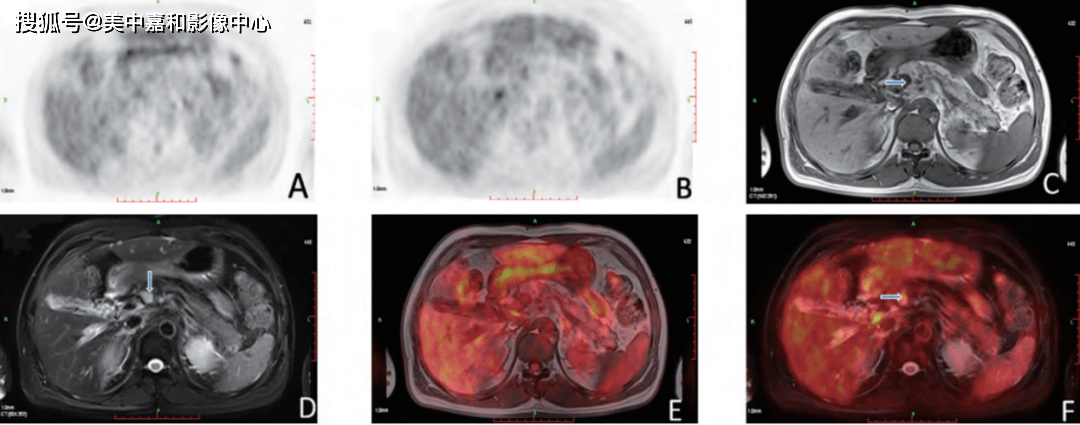 腹部不适来查原因，不想竟是肝门部胆管癌！_肿瘤_手术_诊断