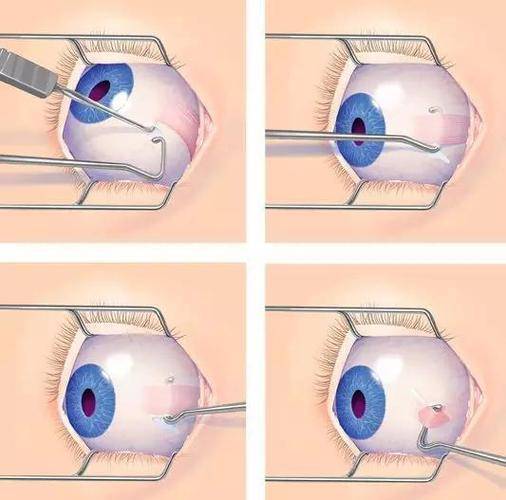 斜视手术全过程图片图片