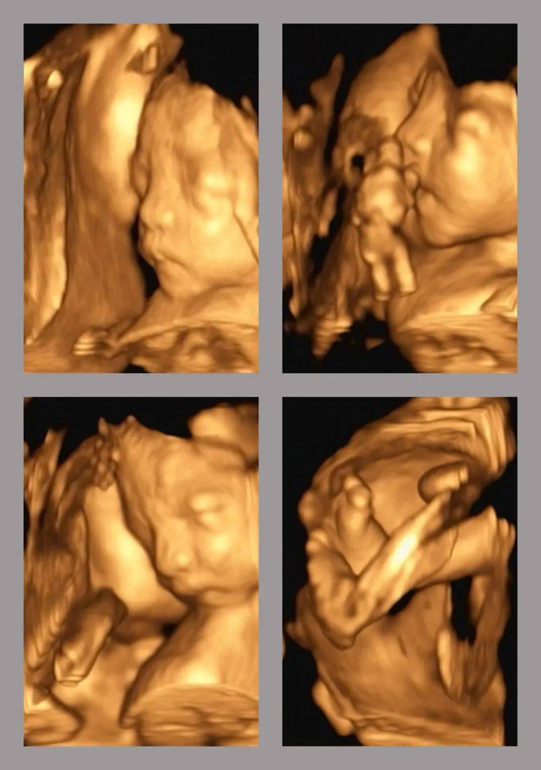 孕十二周四维彩超图片