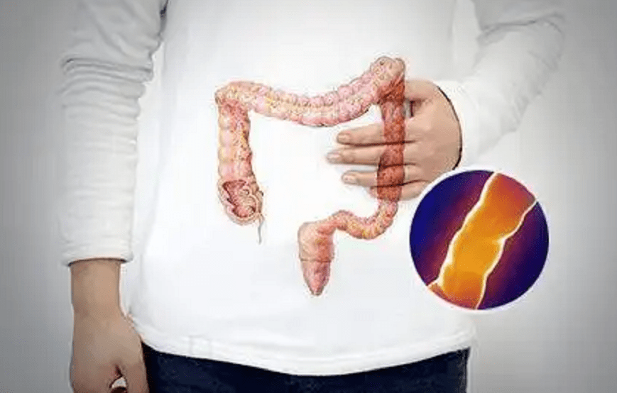 为多种直肠疾病的共性表现,如痔疮,肛裂,直肠炎症,直肠息肉,直肠癌,肠