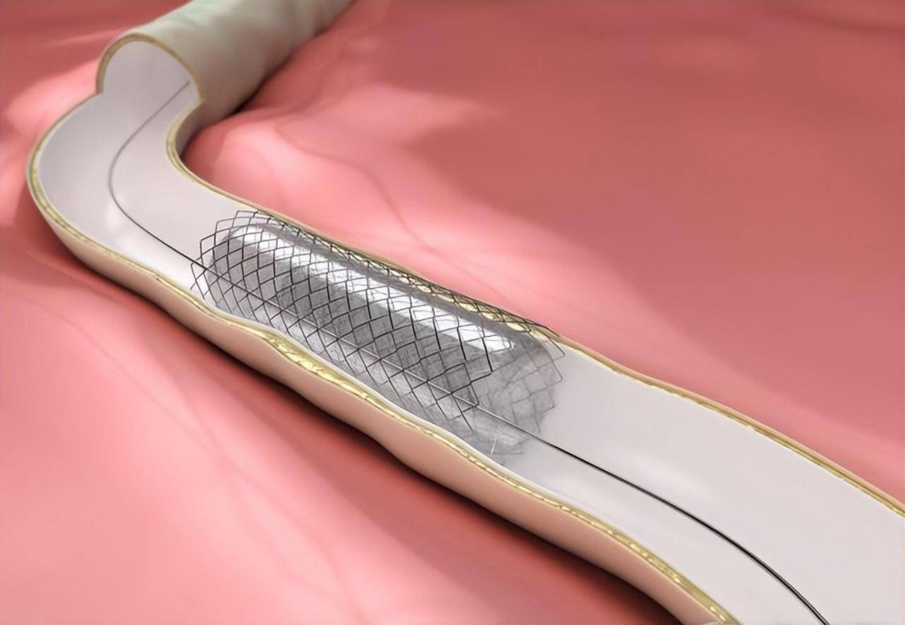 心脏支架,3年后心梗血管又堵塞了!支架为啥不能预防心梗猝死?_风险_药