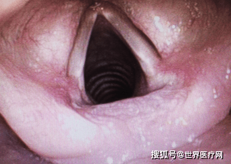 横跨于患者颈前部,导致气管压迫,声门下气管最狭窄处内径仅7毫米左右