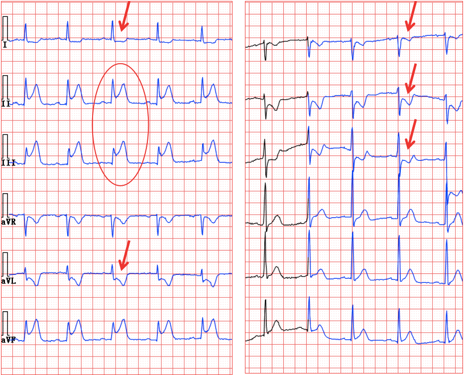 超急性期下壁心肌梗死 ii,iii,avf 导联 st 段抬高,iii 