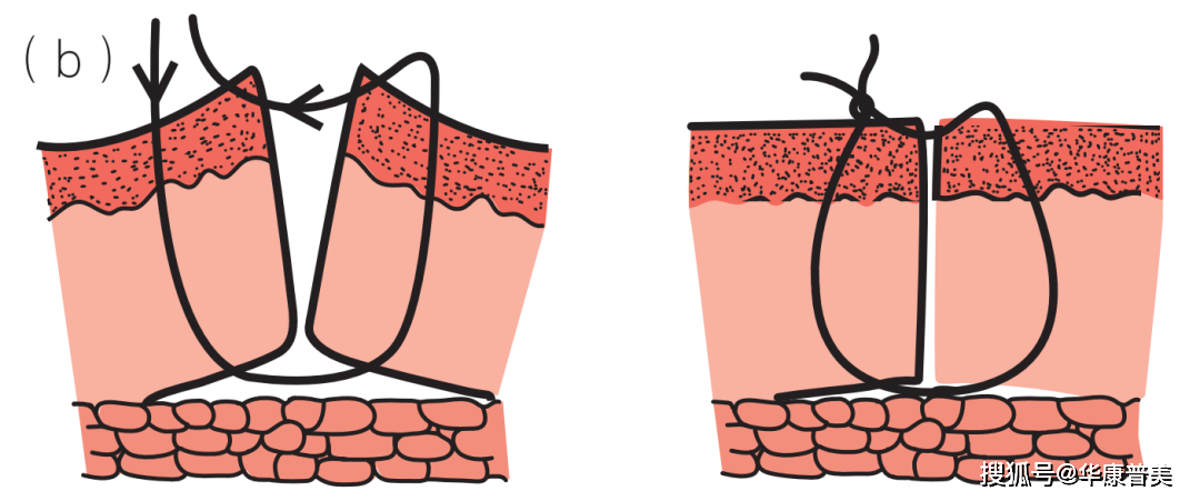 缝合常见的问题及处理小技巧_皮肤_缝线_张力