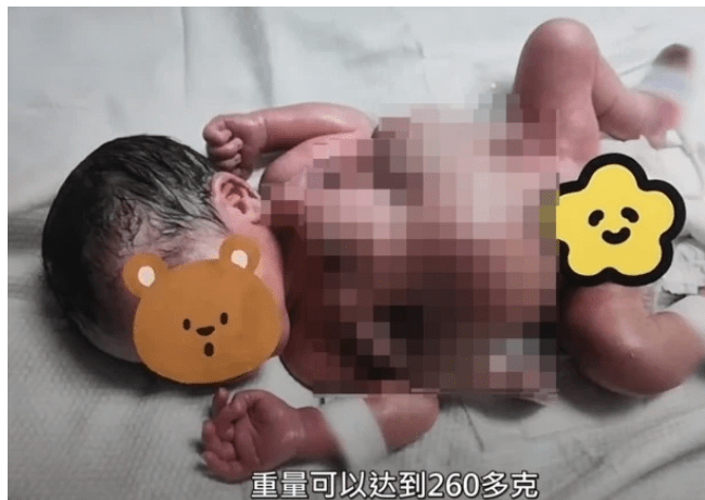 深圳一男婴出生时四手四脚，她肚子里的两个胎儿是“粘”在一起的。