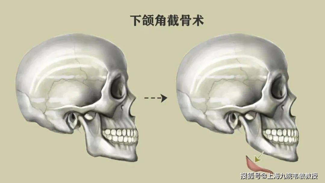 下颌角宽大如何改善_手术_进行_医生