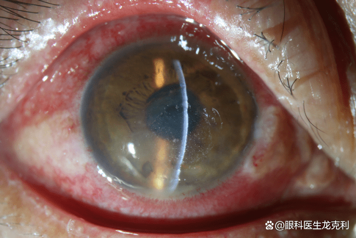 术后第1天,角膜水肿及基质浸润相比术前明显减轻陈阿姨在进行一次角膜