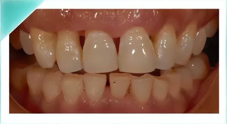 不少人都有的牙齿"黑三角",竟然比蛀牙还可怕_牙龈_炎症_重点